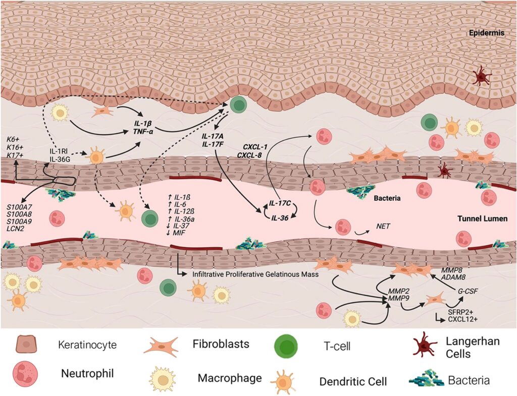 New insights in how tunnels work in hidradenitis suppurativa. fig1