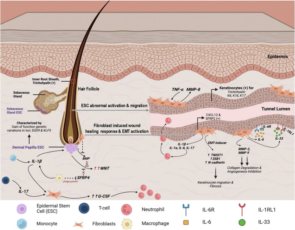 New insights in how tunnels work in hidradenitis suppurativa. fig2