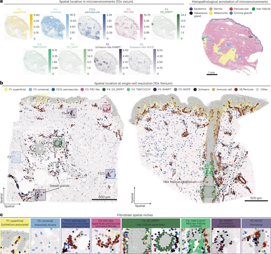 The Architect and the Arsonist: A Breakthrough Study Reveals the Rogue Fibroblasts Cells Behind HS fig 2
