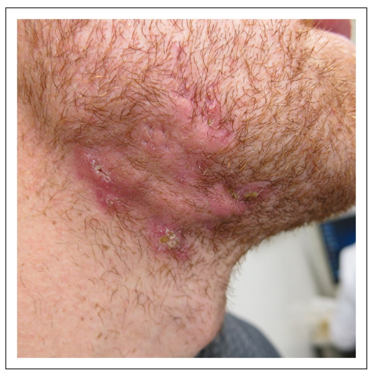 How to Treat Hidradenitis Suppurativa on Your Face: A Scientist's Perspective screenshot 2025 09 22 190002