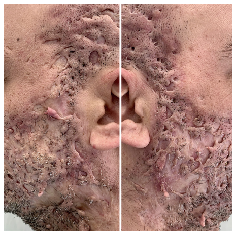 How to Treat Hidradenitis Suppurativa on Your Face: A Scientist's Perspective screenshot 2025 09 22 190158