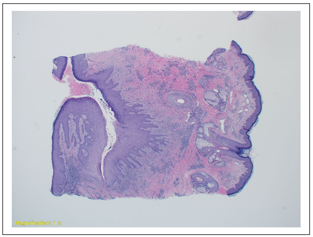 How to Treat Hidradenitis Suppurativa on Your Face: A Scientist's Perspective screenshot 2025 09 22 190840