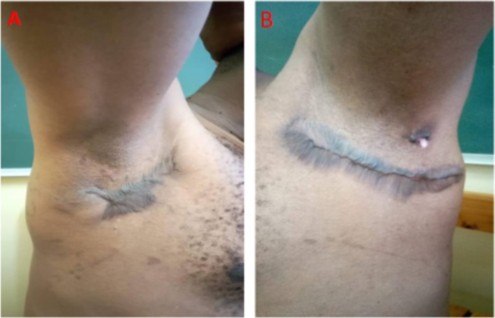 This HS Patient Was "Cured" by Surgery. Or Was He? A Closer Look ccr3 13 e71176 g002