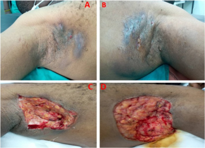 This HS Patient Was "Cured" by Surgery. Or Was He? A Closer Look ccr3 13 e71176 g003