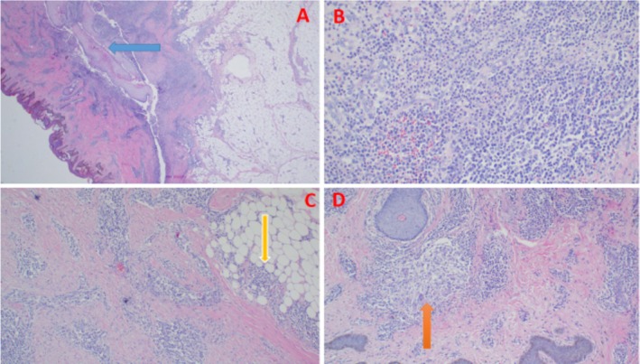 This HS Patient Was "Cured" by Surgery. Or Was He? A Closer Look ccr3 13 e71176 g004