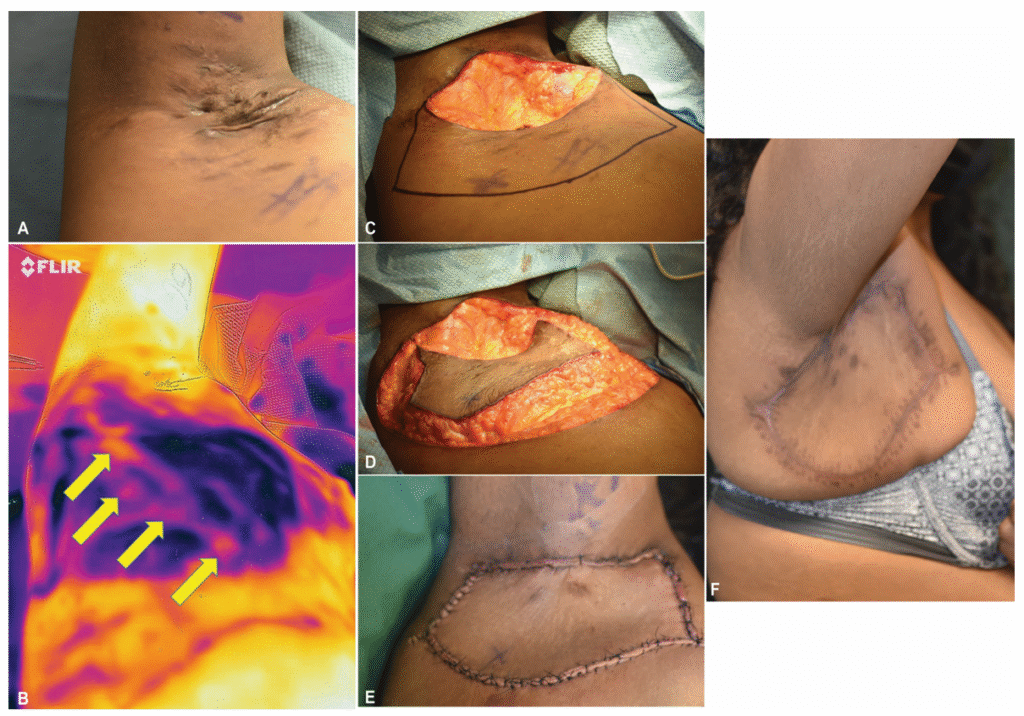 Keystone Flap Surgery for Armpit Hidradenitis Suppurativa: A Simpler Surgery, But Does It Solve the Real Problem? screenshot 2025 10 23 232704