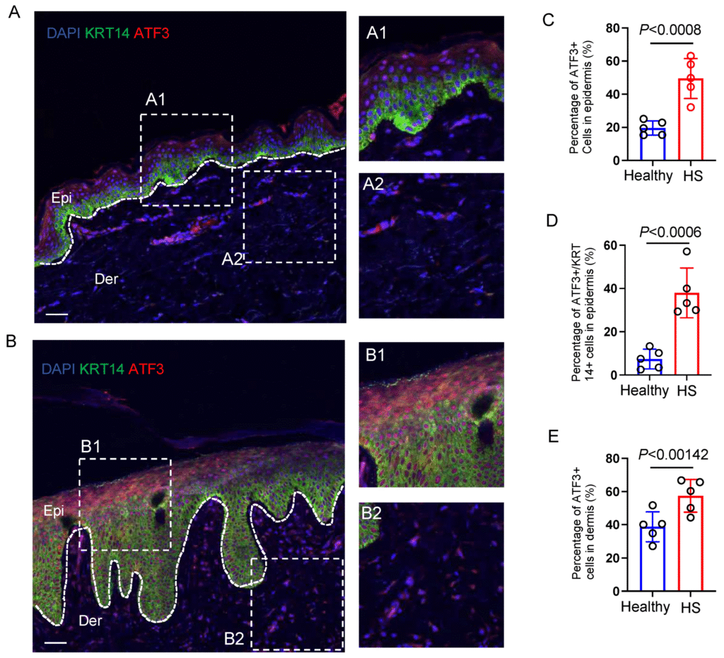 How to Treat Hidradenitis Suppurativa: Understanding Your Skin's Epigenetic Switches with New Research biomedicines 13 01599 g005