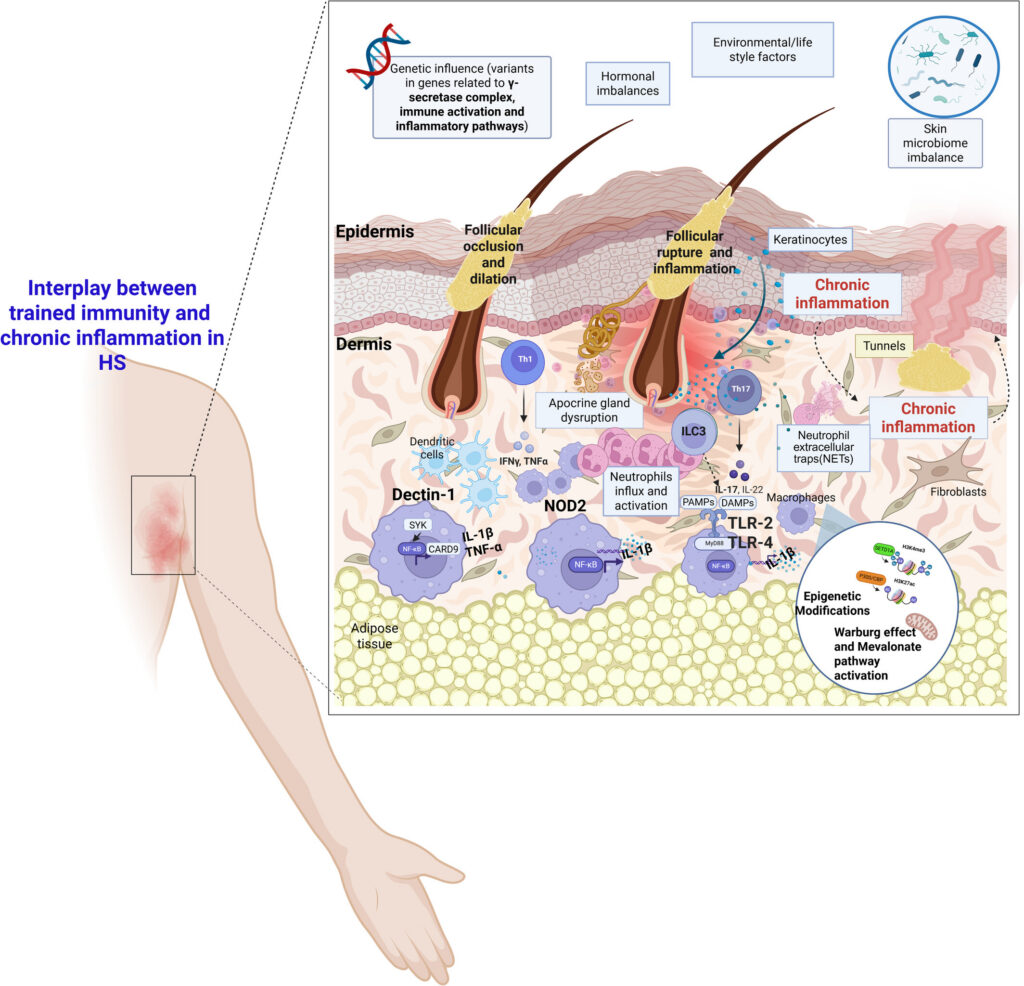 Stuck on Attack Mode? How "Trained Immunity" Explains Persistent Hidradenitis Suppurativa Flares exd70160 fig 0001 m