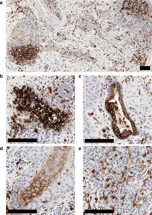 Stronger Confirmation: New Genetic Clue Solidifies Hidradenitis Suppurativa's Autoimmune Link gr2